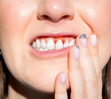Gingivitis gum disease