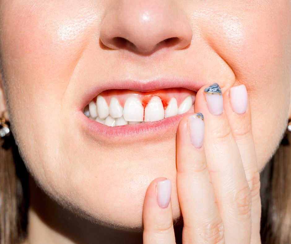 Gingivitis gum disease