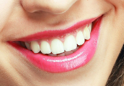 teeth whitening and hygiene
